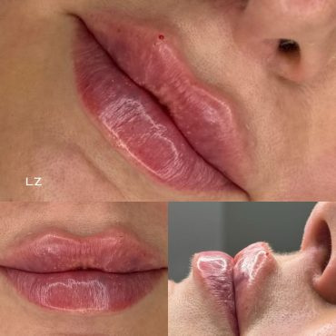 Harmonização Orofacial